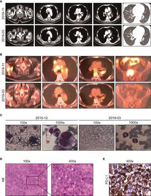 Frontiers Case Report Successful Immunotherapy Improved The Prognosis Of The Unfavorable